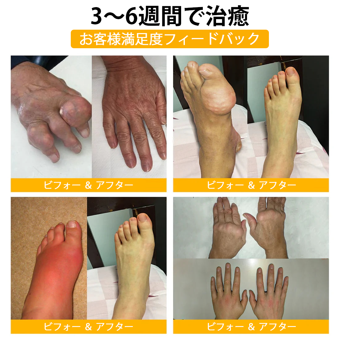 WarmFamily® ボツリヌストキシン&蜂毒配合 骨治癒促進鎮痛クリーム🐝