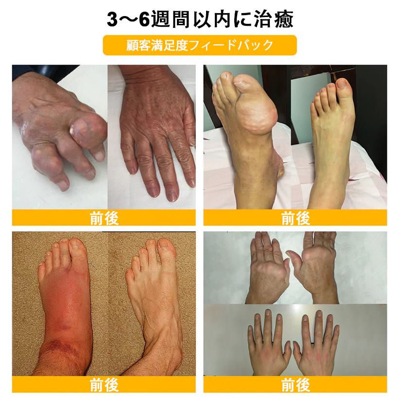 アメリカ製✅🇺🇸TLOPA® ボツリヌストキシン&蜂毒 骨・関節サポートクリーム (👴高齢の方におすすめ!整形外科医も推奨🐝)
