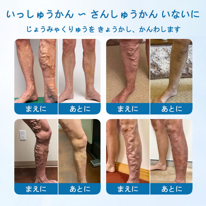 Timilk®ベインガードハーブスプレー✅✅ 臨床的に、わずか7日間で静脈瘤を解消することが証明されています！