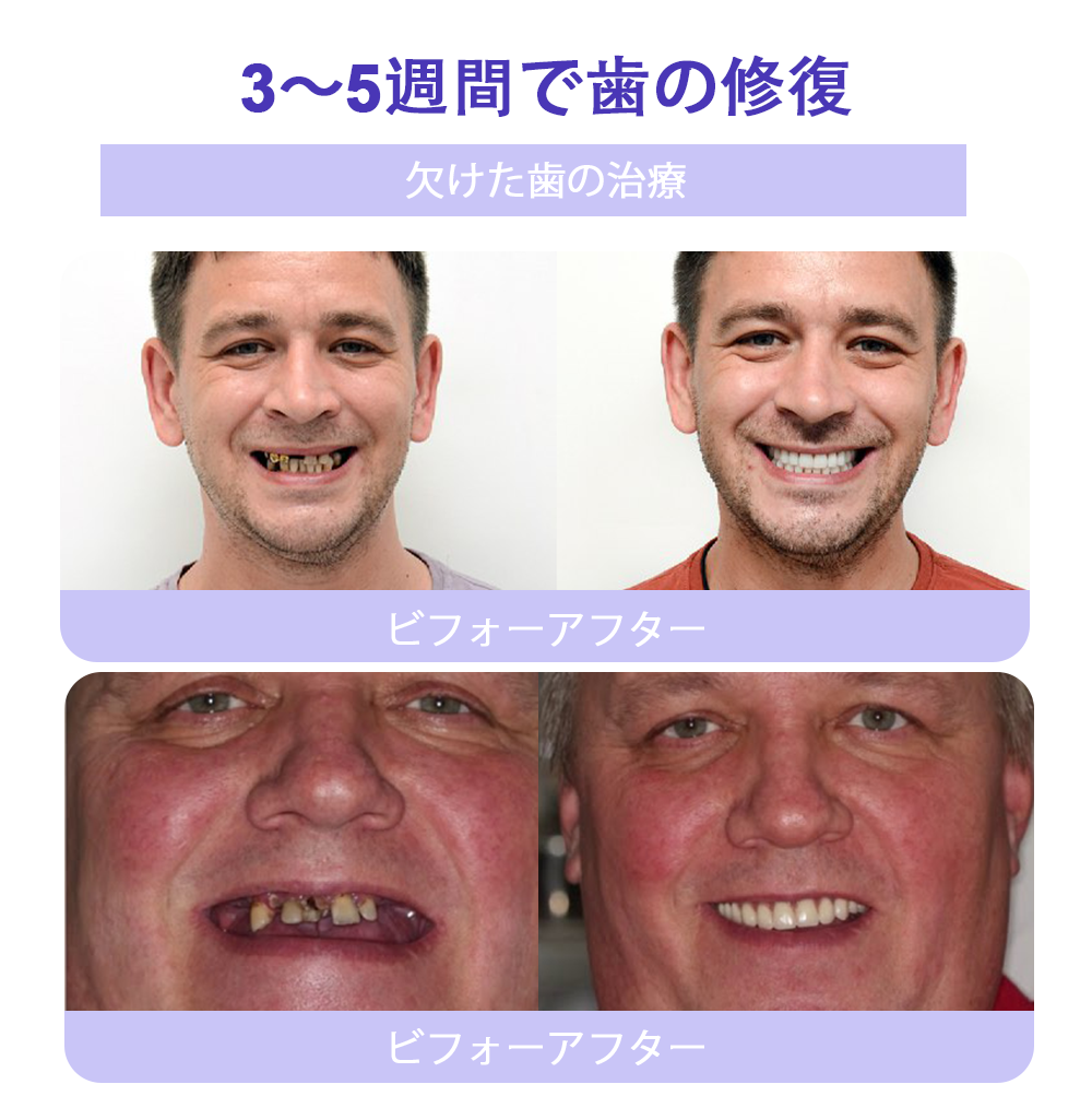 Cvreoz®（ADA推奨）ミネラル歯修復パウダー 🦷 残り30分限定！特別割引実施中 🦷
