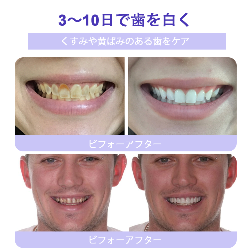 Cvreoz®（ADA推奨）ミネラル歯修復パウダー 🦷 残り30分限定！特別割引実施中 🦷